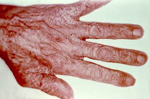 This person’s hand reveals a scabies infestation, especially visible in the area of the webbing between the fingers. Credit: Reed and Carnrich Pharmaceuticals. This person’s hand reveals a scabies infestation, especially visible in the area of the webbing between the fingers. Credit: Reed and Carnrich Pharmaceuticals.